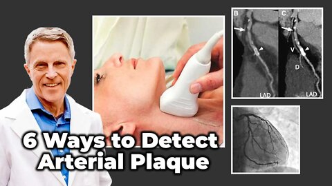 6 Ways to Detect Arterial Plaque