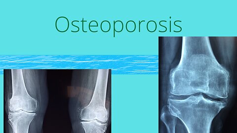 Osteoporosis y Agua de Mar