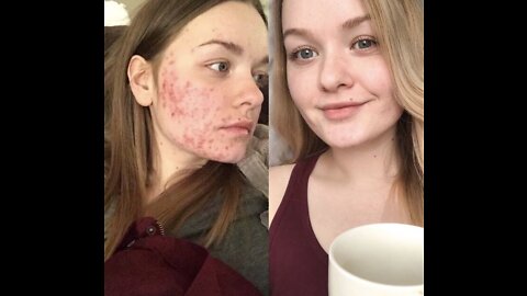 HOW I CLEARED MY ACNE FOR GOOD IN ONE WEEK (NO ACCUTANE)