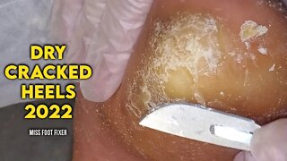 DIY DRY CRACKED HEELS 2022 | HOW TO TREAT CRACKED HEELS FULL TREATMENT BY MISS FOOT FIXER