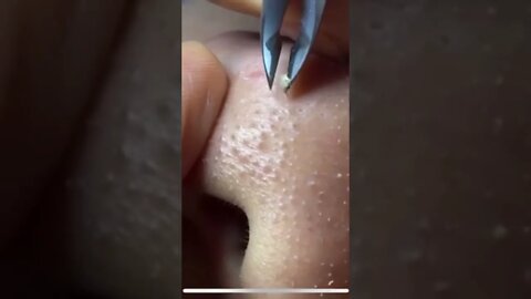 Remoção de Cravos e Espinhas - Remove Squeezing Blackheads and Pimples - Just Relax | Apenas Relaxe