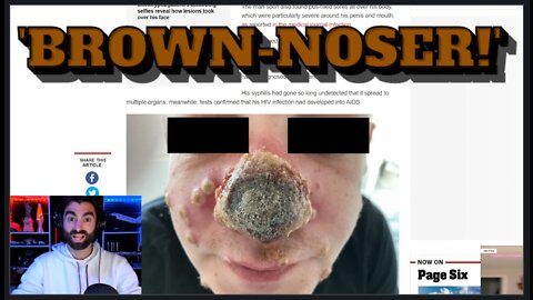 ROTTEN! Gay Man With Undiagnosed AIDS, Syphilis Loses His NOSE To Monkeypox!