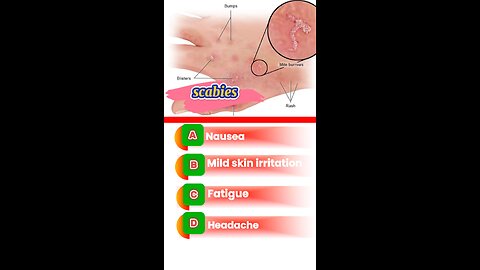 Scabies question answers mcqs #Scabies #skin #allergyproblems #drugs #pharmacology ##health