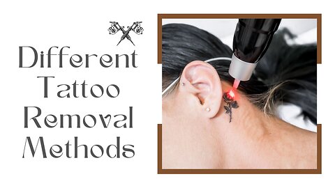 Different Tattoo Removal Methods