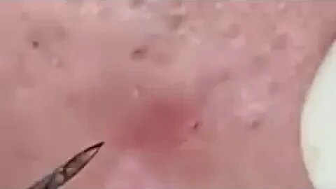 Pimple Popping Blackheads DOSKf nCS3k 480p 1655178156087