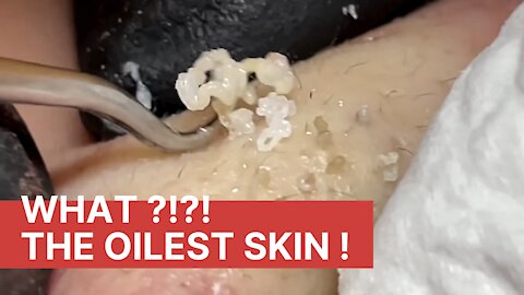 What?! Huge Blackheads removal 1