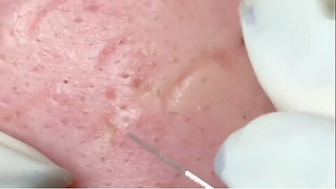 Satisfying whiteheads removal!