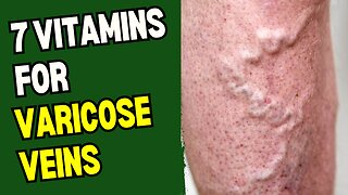 7 Vitamins For Varicose Veins