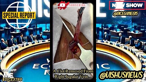 A Clot Removed From Right Jugular Vein... #VishusTv 📺