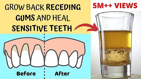 How to Treat Sensitive Teeth | Reverse Receding Gums| Effective Solutions