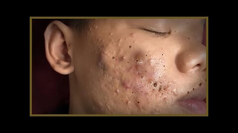 Dr Pimple Popper Cystic Acne Extraction