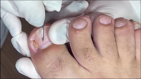 Removendo a unha encravada em tempo recorde: veja como fizemos #ingrown_toenail #unhaencravada