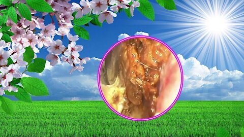 Cholesteatoma Earwax Removal #06