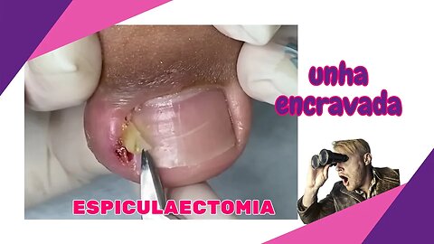 Procedimento SATISFATÓRIO de UNHA ENCRAVADA #unhas #pes #dor #podologia #espiculaectomia