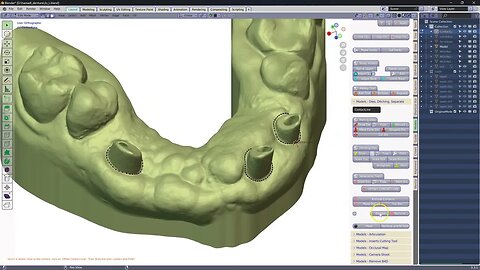 Making a bridge on implant posts