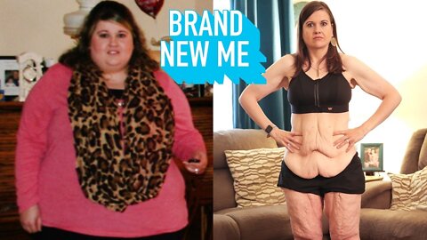 My 260lbs weight loss Left me with 20lbs off skin | brand new me