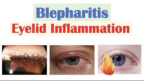 Blepharitis (Eyelid Inflammation) | Causes, Risk Factors, Signs & Symptoms, Diagnosis, Treatment