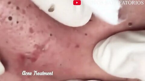 Satisfactory Video Blackhead Removal Skin Cleansing #1