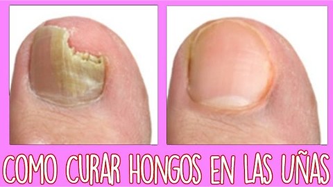 Hongos en las uñas delos pies