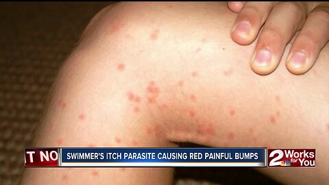 HN2U: Swimmer's itch parasite causing red painful bumps