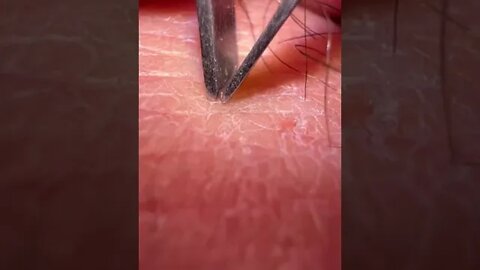 Zoomed & Precise Ingrown Hair Removal