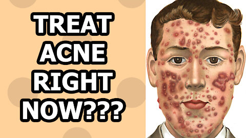 What is Acne And How To Treat Acne