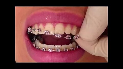 Life After Orthodontic Braces By Dr Mike Mew