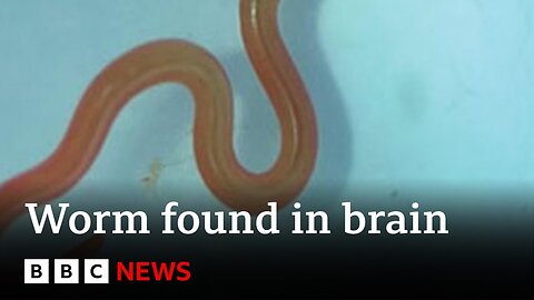 Live worm found in Australian woman's brain