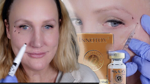 Crows Feet Innotox | Gorgeously Aging