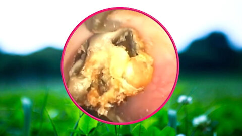 Ear Wax Removal With Clam Relaxing Music #03