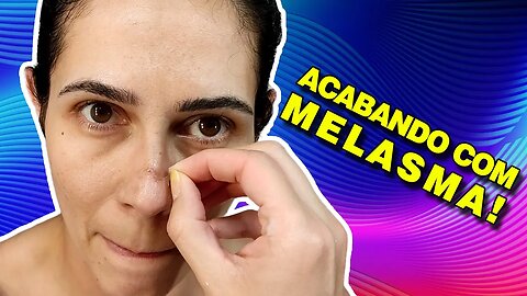 Melasma: Como Eliminei! Vitacid Plus + EPSOL = Pele Impecável!