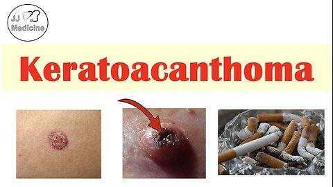 Keratoacanthoma (Rapidly Growing Skin Lesion) | Risk Factors, Stages, Symptoms, Diagnosis, Treatment