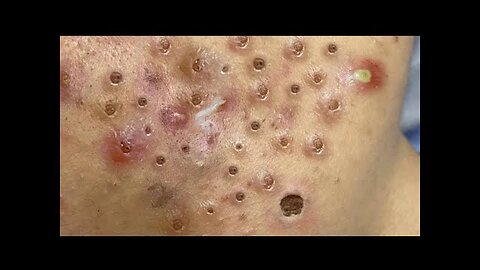 Super Satisfying Blackhead Acne Removing Pimple Popping Compilation ASMR