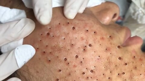 Removing Acne and Blackheads Treatment, #22