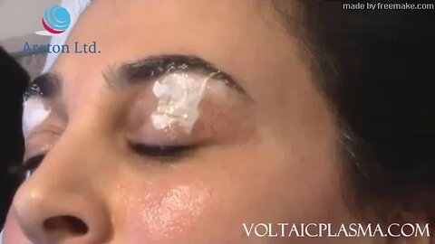 Plasma Upper Eyelids Tightening training, Before, Healing and Afters