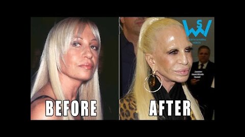 Top 10 Before And After Celebrity Plastic Surgery Fails That Will Scare You