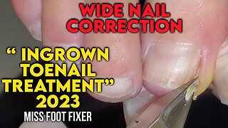 Wide Nail Correction 2023 | Treatment of a Ingrown Toenail by foot specialist miss foot fixer