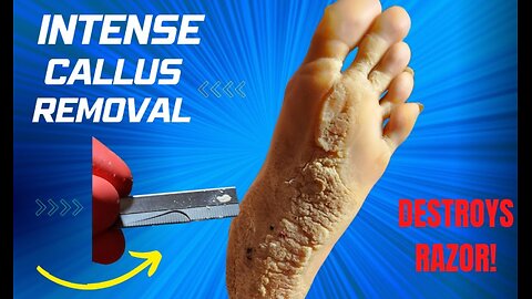 INTENSE CALLUS REMOVAL!!