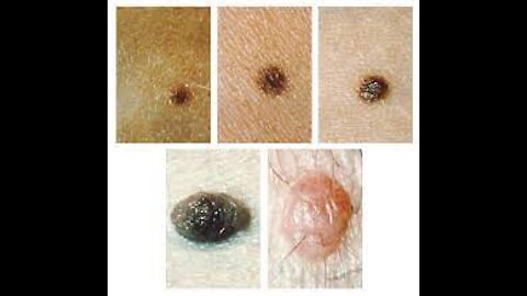 What Are 5 Types of Skin Moles