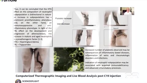 Thermographic Imaging Shows Massive Blood Clots in the Asymptomatic Vaxxed