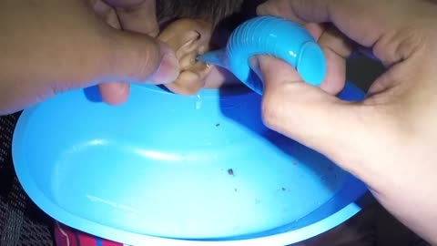 Removing Boy_s Earwax by EAR Irrigation