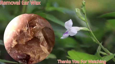 gigantic ear wax removal #7