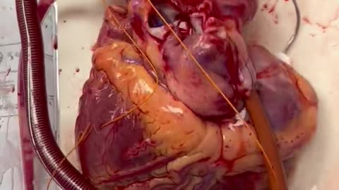 Heart Surgery