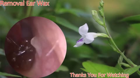 gigantic ear wax removal #13