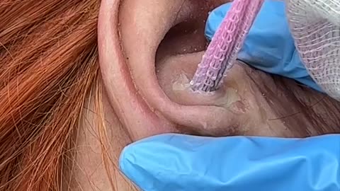 Strange material removed from ear