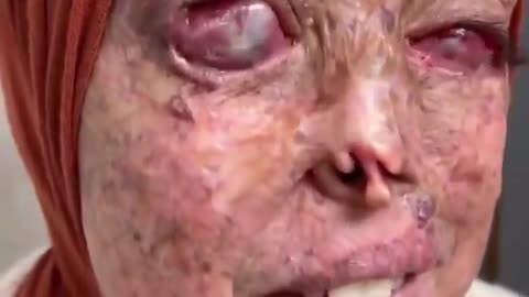 This woman is a victim of white phosphorus bombs dropped by Esraeli