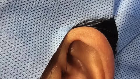 Ear Lobe Piercing by Gunshot by Dr. Kavitha GV Mandal | Dermatologist in Sarjapur Road, Bangalore