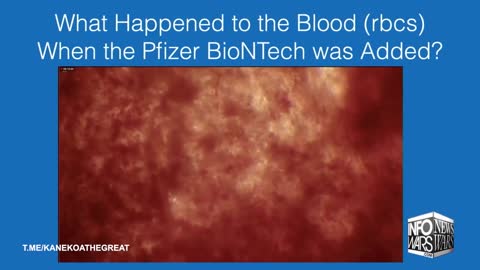 Dr. Richard Fleming: Pfizer Vaccine Causes Blood Clots Under Microscope