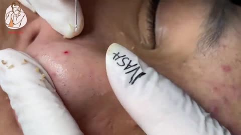 Satisfying moved blackhead comedo