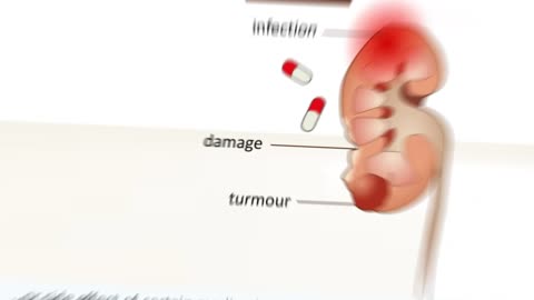 Decoding Kidney Disease Understanding Causes and Treatment for Kidney Failure